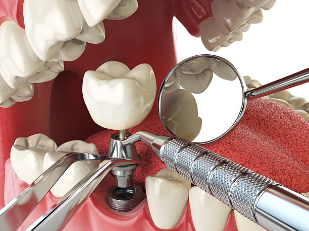 Best Root Canal Emergency Dentist  in Indian River, MI